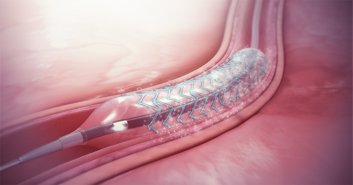 stents