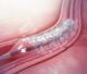 Maior estudo do mundo com stents em diabéticos reafirma eficácia do tratamento padrão atual